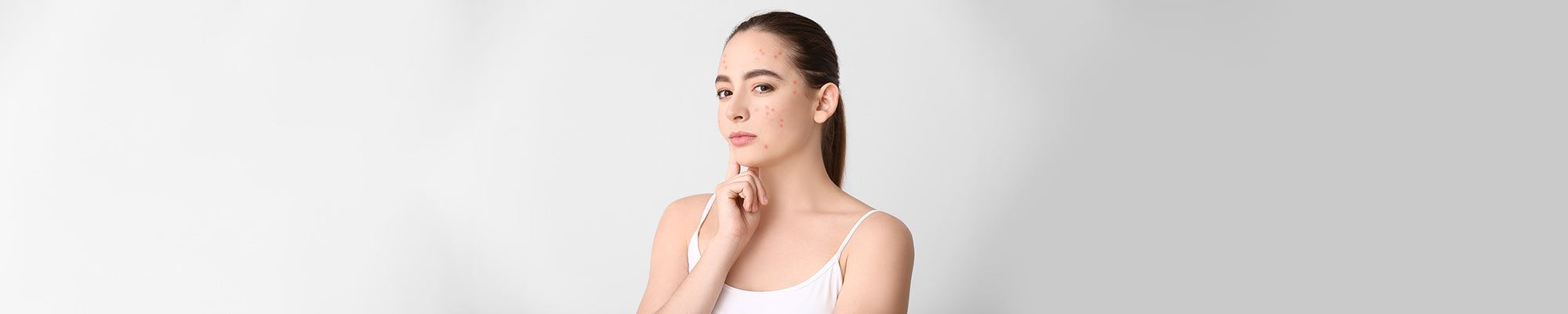 Does Acne Get Worse Before it Gets Better? An Explorative Piece