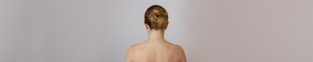 Shoulder Acne - Important Things You Ought to Know