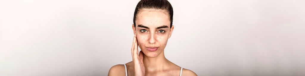 What is the Right Way to Treat Acne?